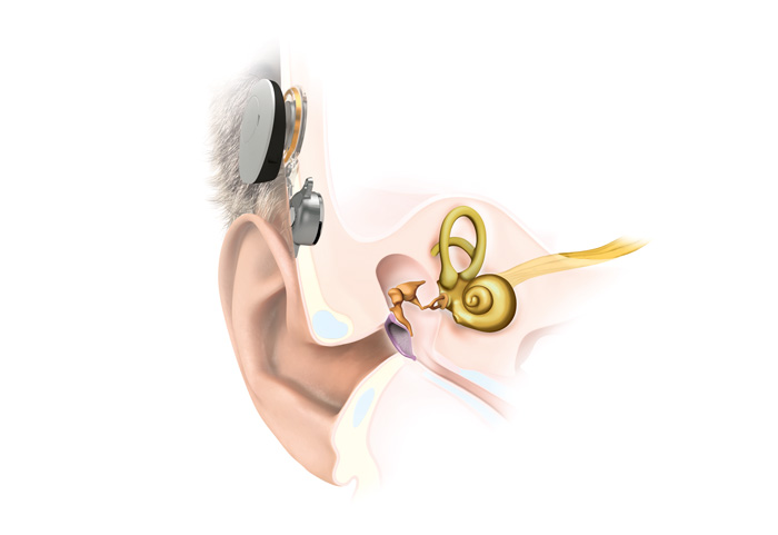 Das neue Hearable