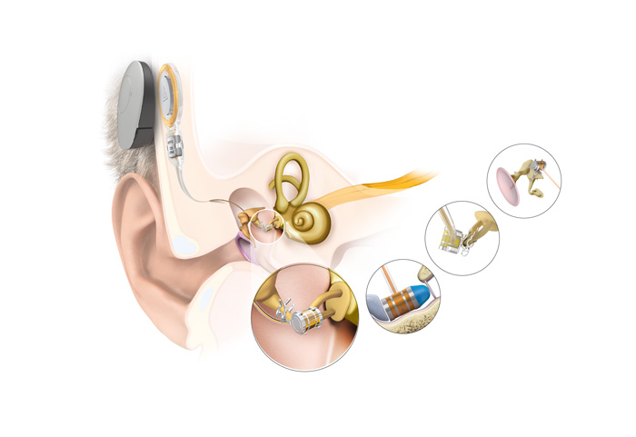 Das neue Hearable
